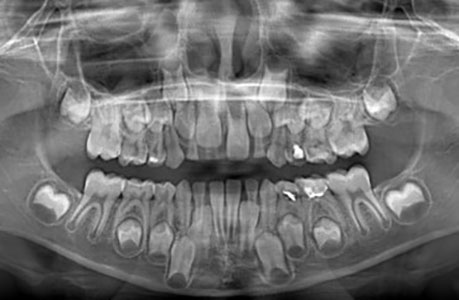 Зачем делать рентген зубов ребенку?